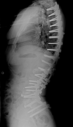 After corrective scoliosis surgery to untwist and straighten her spine, Marilyn’s lumbar curve and right thoracic curve has improved to 28 degrees and 17 degrees respectively.