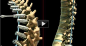 austin texas dr geck spine and scoliosis videos and procedures, patient educational videos texas