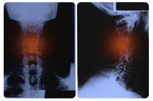 What is spine cancer called?